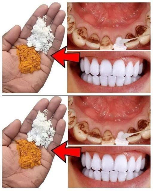 Natural Remedies with Cloves and Bay Leaves for a Brighter Smile…