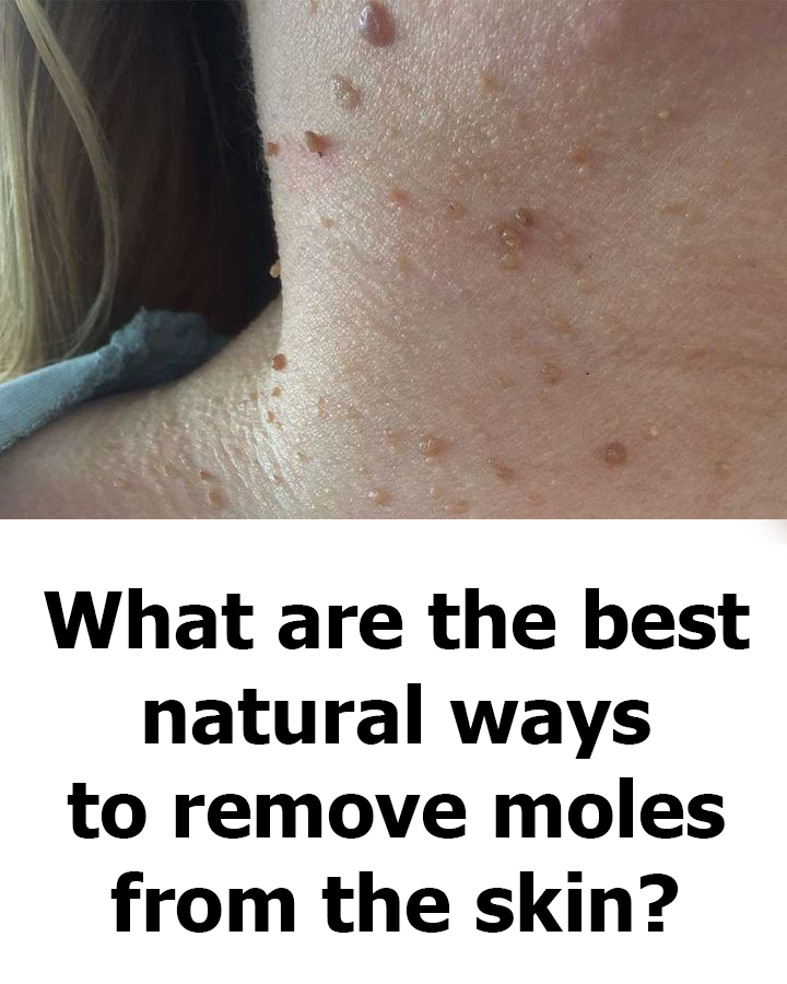 What are the best natural ways to remove moles from the skin?