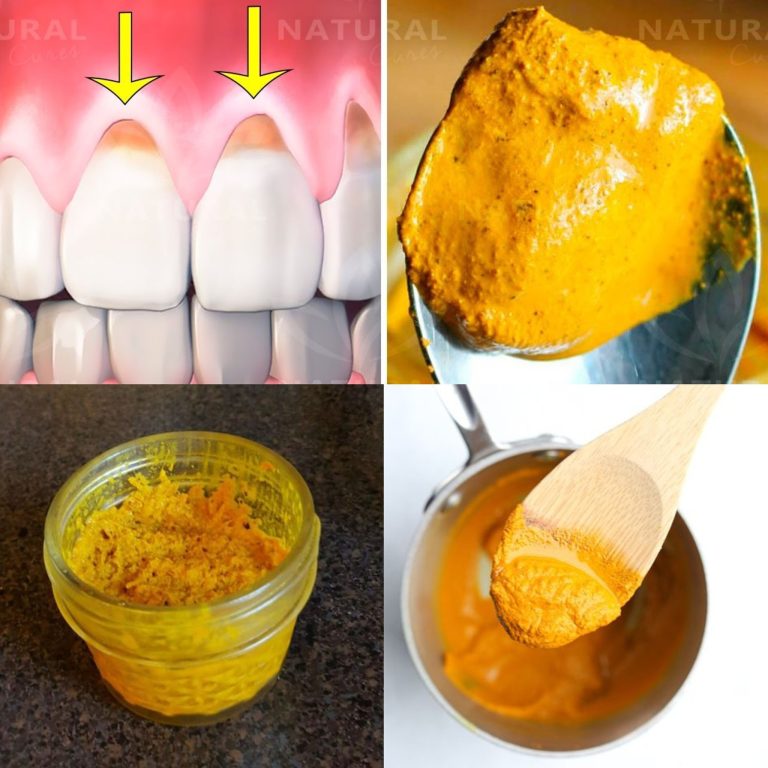 Secret that Dentists Don’t Want You to Know: Remove Tartar and Whiten Teeth in Just 2 Minutes with Turmeric