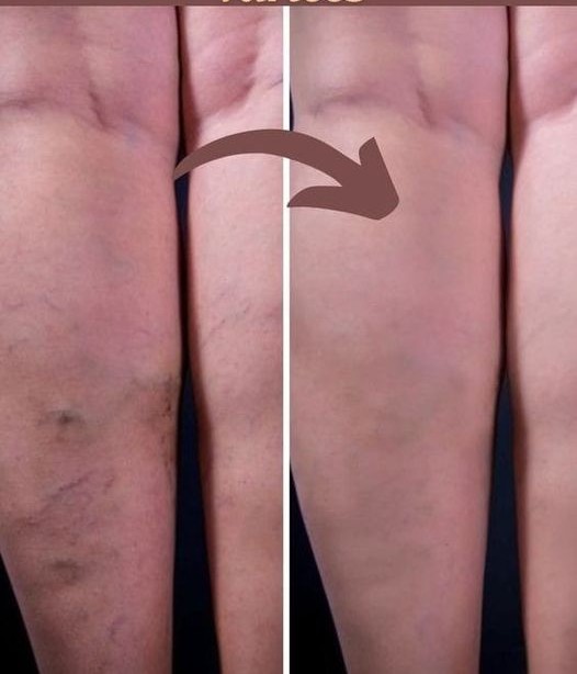 Unknown grandmother against varicose veins