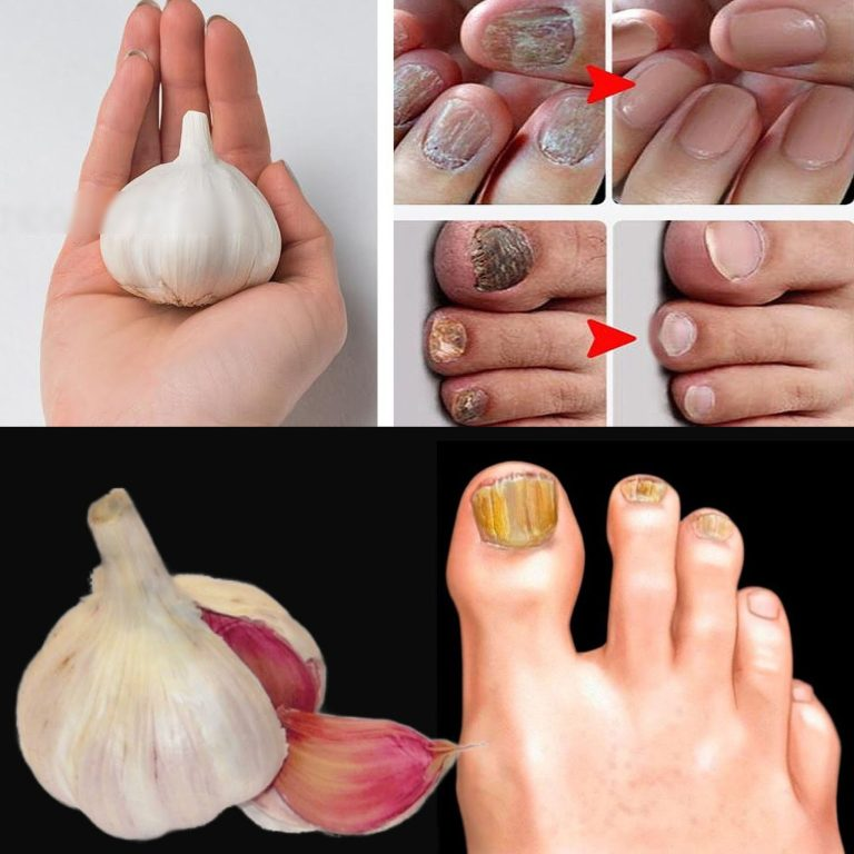 Erase Nail Fungus Naturally: Discover the Power of Garlic