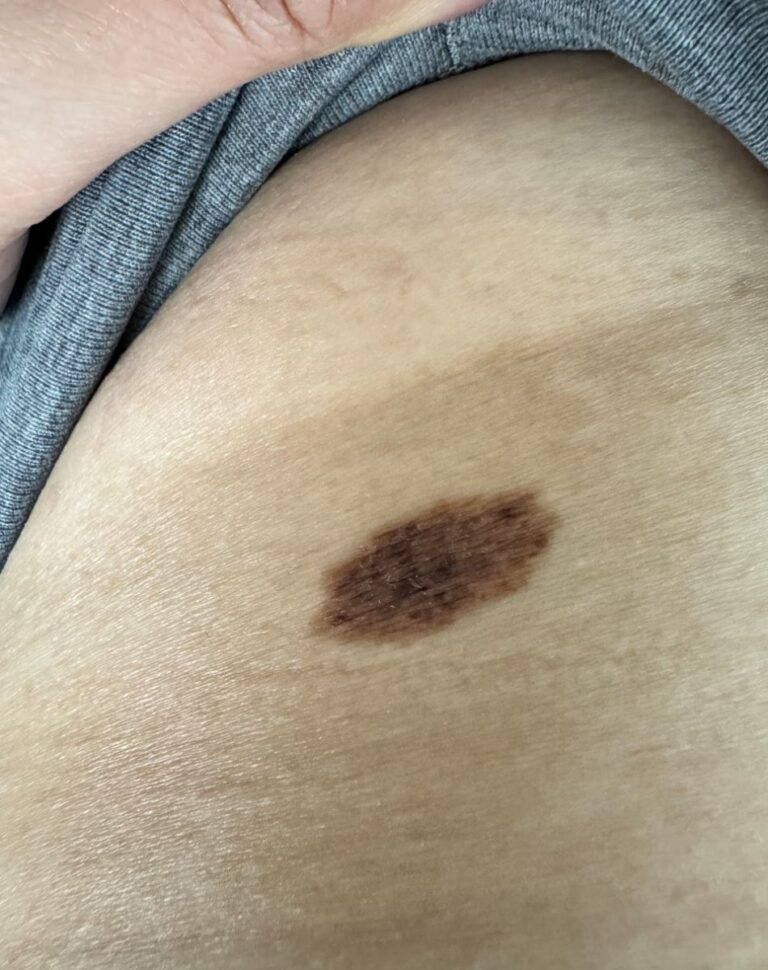 I have this mole that has patchy dark spots on it. What should I do?