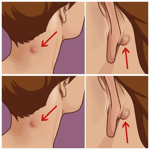 Do you have such NODES on your NECK, BACK, or near your EAR