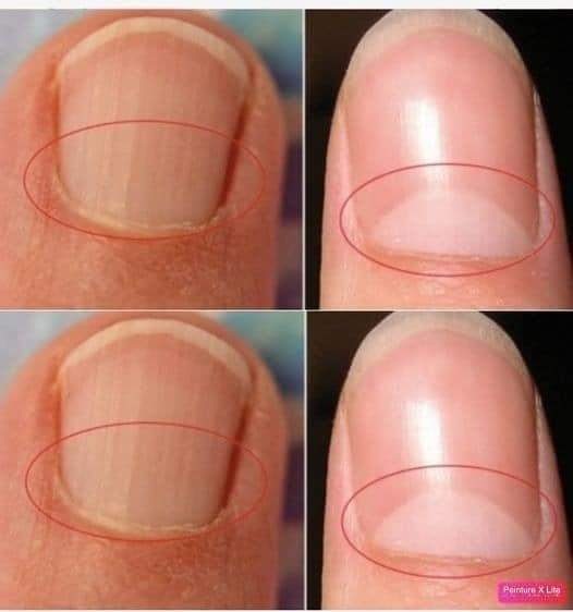 If your nails do not form a half-moon shape, see a doctor immediately.