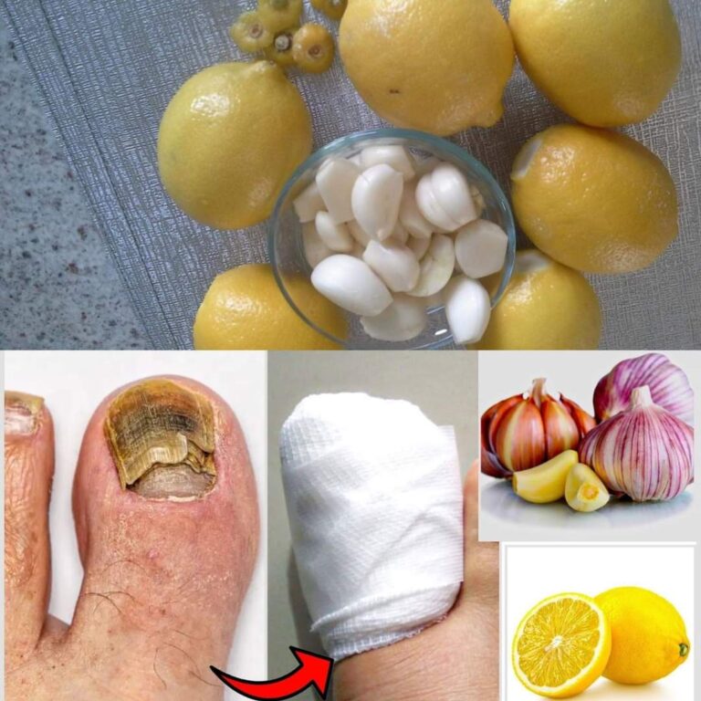 Lemon and Garlic Remedies for Nail Fungus and Excessive Sweating