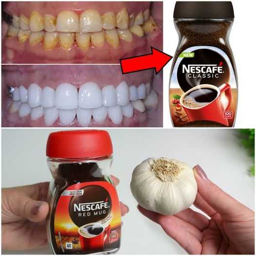 Natural teeth whitening at home: a surprising solution based on garlic and coffee