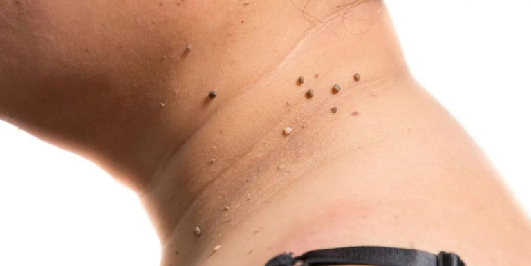 Skin tags: what do these growths on the skin mean?