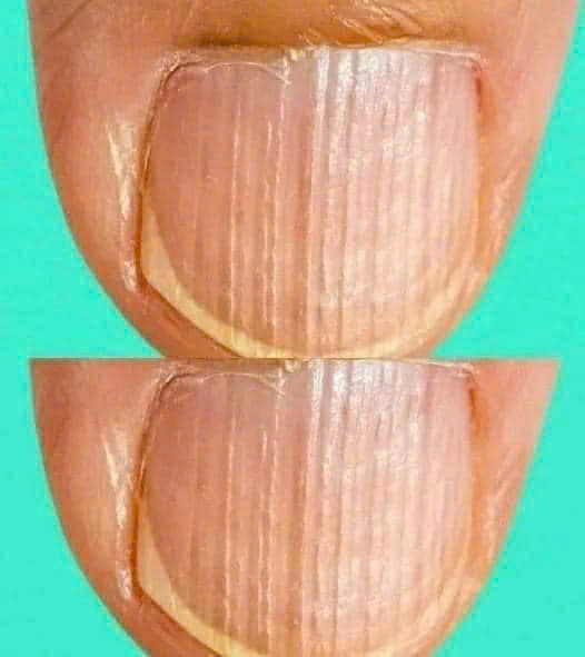 Rippled fingernails reveal secrets of possible disease