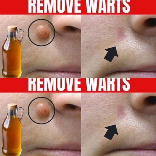 Apple cider vinegar can help get rid of warts quickly