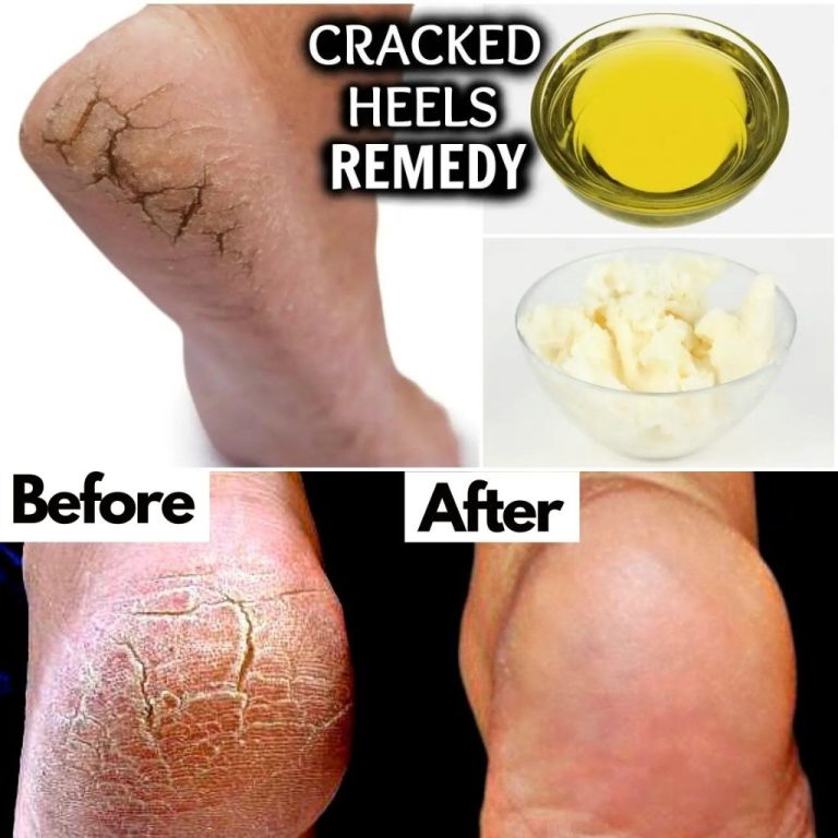 How to Treat Cracked Feet with 6 Home Remedies 😍GO to the first comment 😍😍