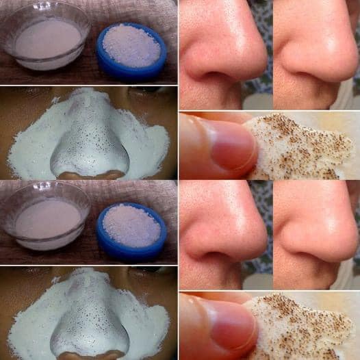 How to Remove Blackheads Naturally