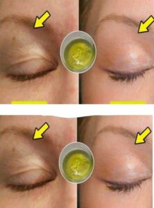 The natural homemade formula to lift drooping eyelids!!