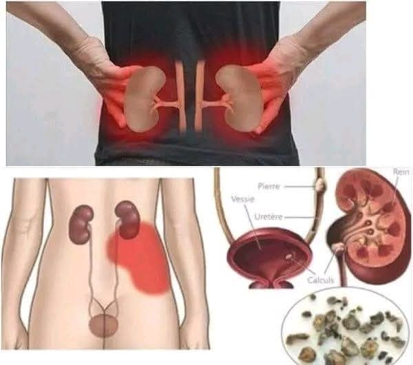 Here are the 6 foods that cleanse your kidneys!!