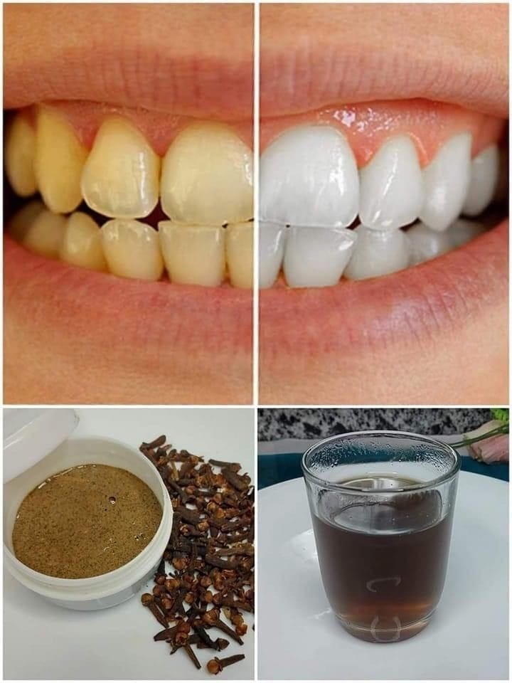 Teeth Whitening: 7 Proven Recipes That Permanently Eliminate Yellowing