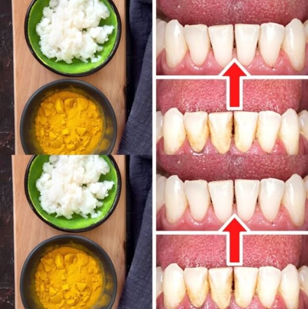 How to Remove Tartar and Plaque Naturally with Turmeric and Salt