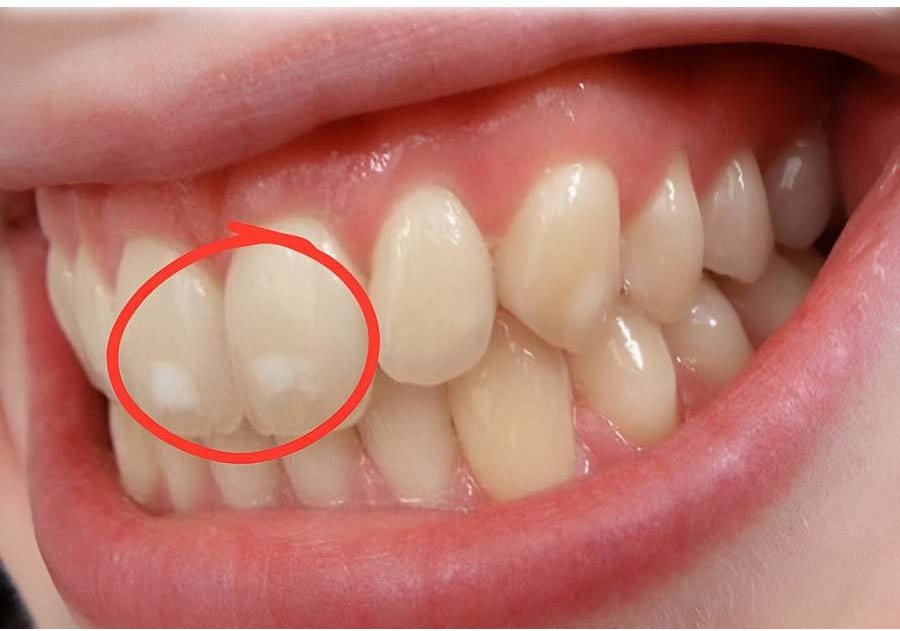 If your teeth have white spots like these, take the situation seriously.