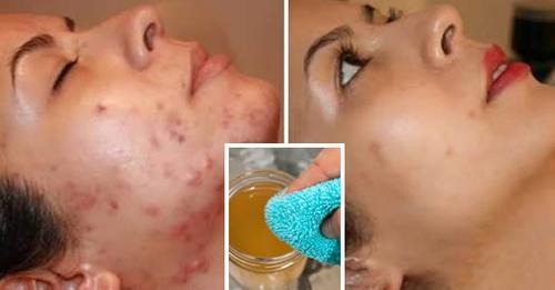 How to Get Rid of Blemishes and Acne with Apple Cider Vinegar