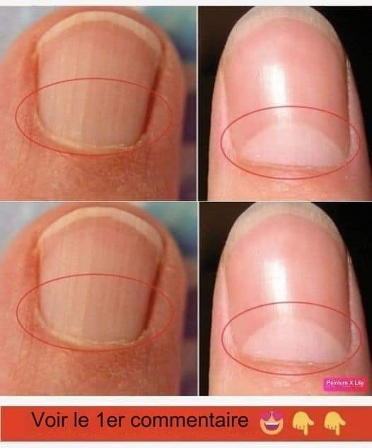 If your nails do not form a half-moon shape, see a doctor immediately.