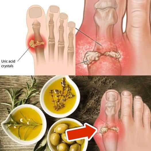 8 Easy Ways to Remove Excess Uric Acid(Easier Than You Think)