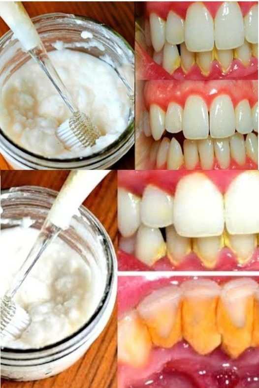 A Simple Way to Get Rid of Bad Breath and Get Rid of Mouth Bacteria