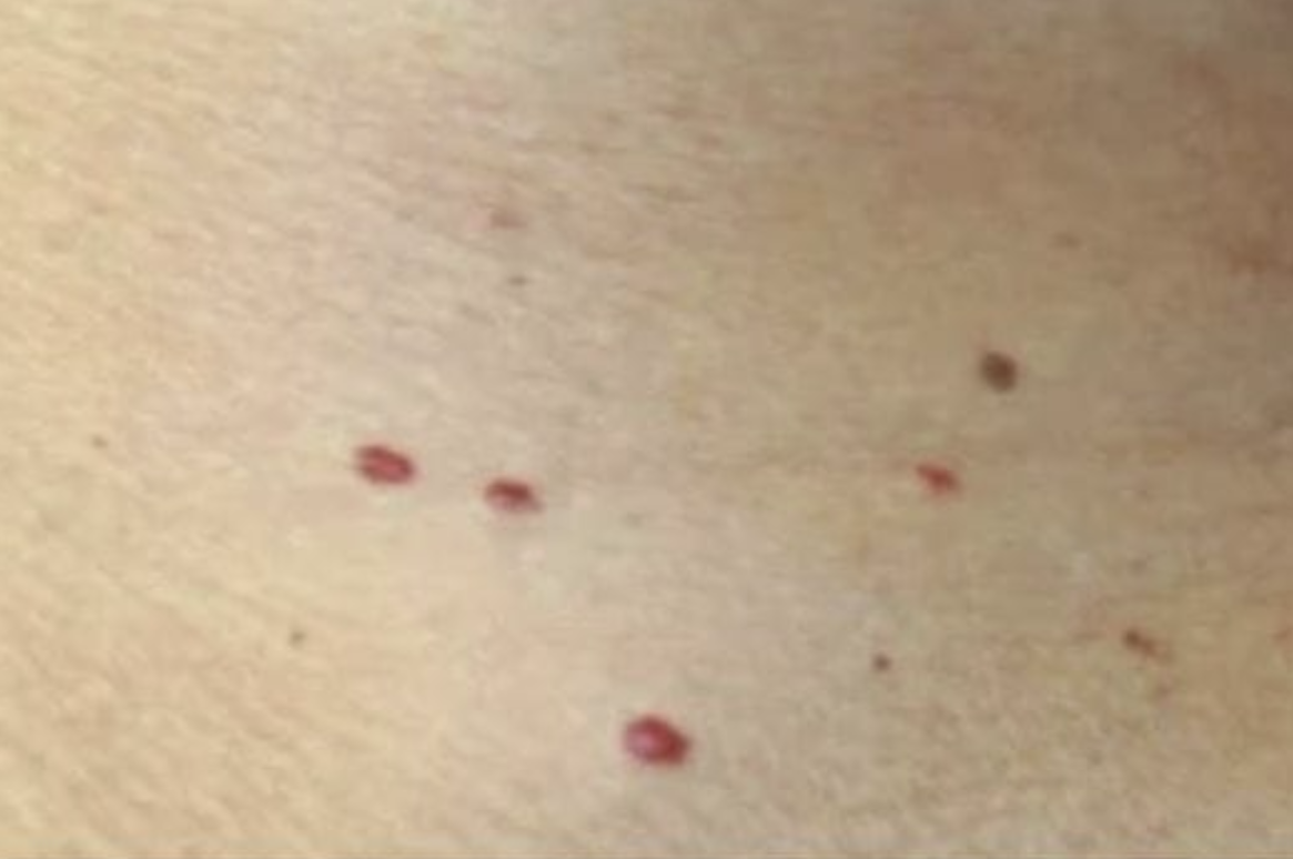 If you spot these red dots on your skin, here’s what they mean