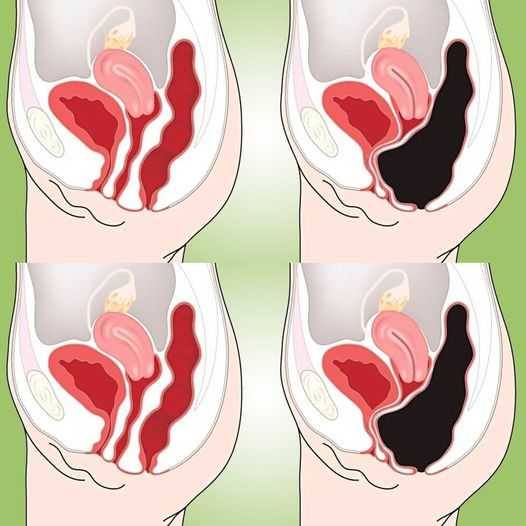 The Natural Way to Cleanse Your Colon at Home